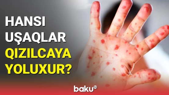Səhiyyə Nazirliyindən qızılca ilə bağlı xəbərdarlıq