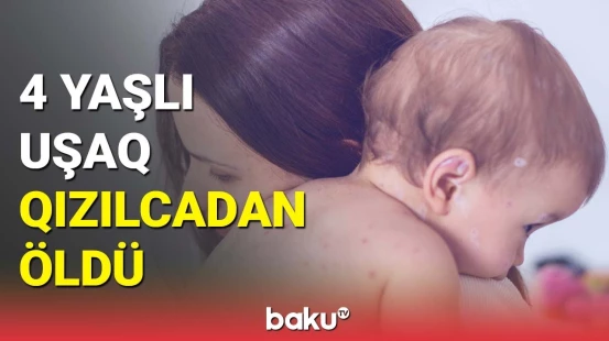 Kürdəmirdə qızılcadan vəfat edən azyaşlının atası danışdı