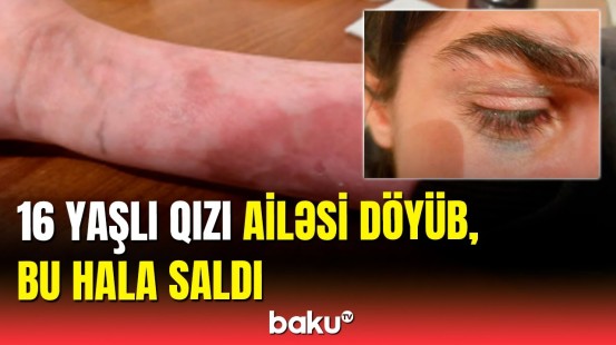 Bakıda döyülən 16 yaşlı qızla bağlı açıqlama