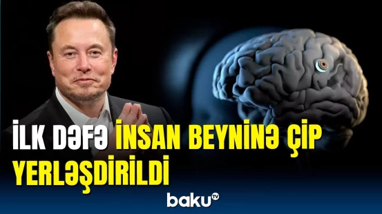 İlon Maskın şirkəti “Neuralink” ilk dəfə insan beyninə çip yerləşdirib