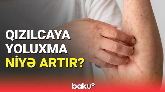 Qızılca xəstəliyinin qarşısının alınma üsulları açıqlandı