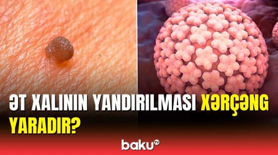 Papillomaların düzgün müalicəsi necə olmalıdır?