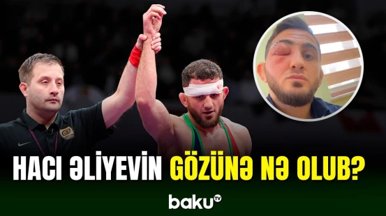 Hacı Əliyevin gözü şişdi | Həkimə müraciət etməli oldu