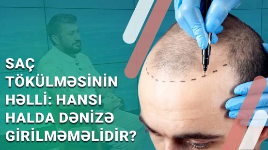 Saç tökülməsinə qarşı nə etməli? - Saç əkimi barədə bütün suallara cavab | BAKU MED