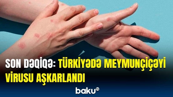 Türkiyə meymunçiçəyi virusu ilə bağlı hərəkətə keçdi | Xəstəliyin əlamətləri açıqlandı