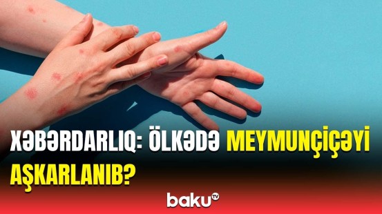 Bu əlamətləri hiss etsəniz... | Meymunçiçəyi ilə bağlı təcili açıqlama