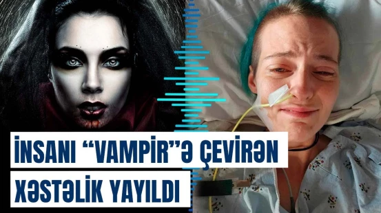 “Vampir” xəstəliyinin əlamətləri | Bu qadın sarımsaq yesə ölə bilər