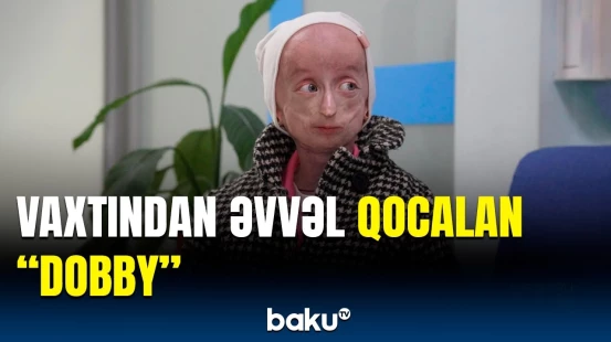 Rusiyalı “Dobby”nin dəhşətli həyat hekayəsi | Dünyada 206 insanda olan nadir xəstəlik