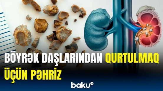 Böyrək daşlarından necə azad olaq? - Gün ərzində 6 qramdan çox...
