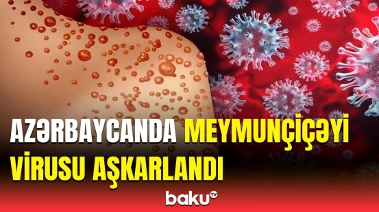 SON DƏQİQƏ: Azərbaycanda bir nəfər meymunçiçəyi virusuna yoluxdu