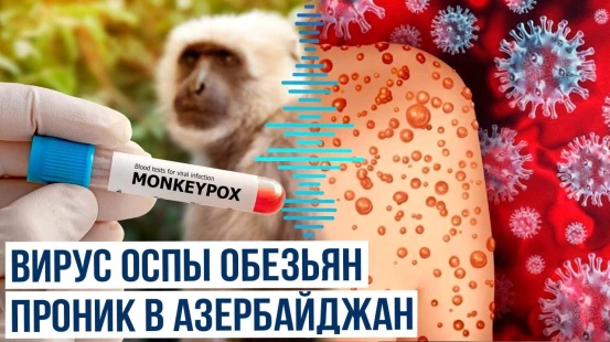 В Азербайджане зафиксирован первый случай заражения оспой обезьян