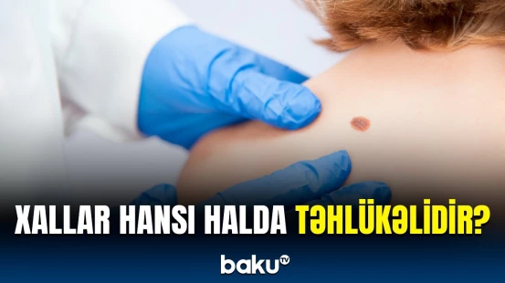 Vaxtında müalicə etməsəniz... | Bədəninizdəki xallarla bağlı bunlara fikir verin