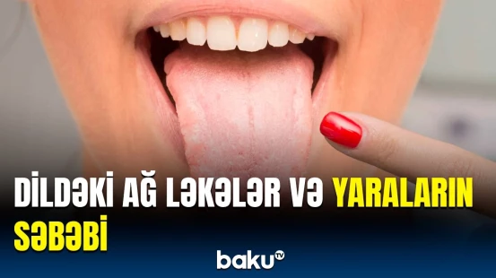 Dil yaralarını müalicə etməyin 5 təbii və sadə üsulu