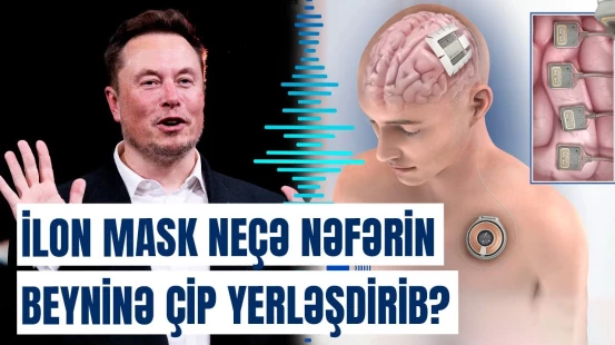 Çiplə yaşamağa başlayan insanların həyatındakı dəyişiklik | Maskdan inqilabi addım