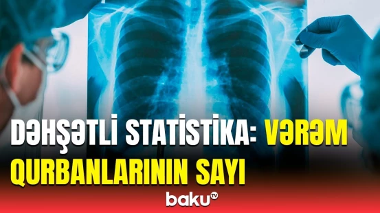 Neçə min şəxs vərəmdən dünyasını dəyişib? | Rəqəmlər açıqlandı