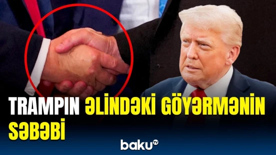 Ağ Ev rəhbərinin əlindəki göyərmə sensasiya yaratdı | Trampın son vəziyyəti açıqlandı