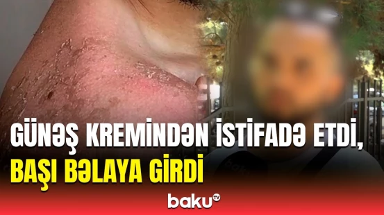 "Dedilər ki, dəri xərçəngi ola bilərsən..." | Dermatoloq həyəcan təbili çaldı