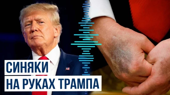 На руках президента США вновь заметили синяки