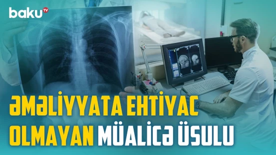 Diaqnoz və müalicədə inqilab | Əməliyyatı əvəz edən prosedur nə qədər effektivdir? - BAKU MED