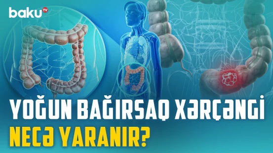 Bütün poliplər təhlükəlidir? - Yoğun bağırsaq xərçənginin qarşısını necə almaq olar? | BAKU MED