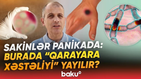 "Qarayara xəstəliyi" diaqnozu təsdiqləndi | Xəstəxanaya müraciət edənlərin sayı artır - Baku TV