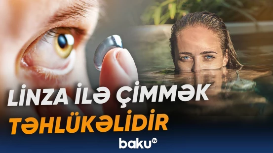 Linzadan istifadə edənlərə oftalmoloqdan xəbərdarlıq