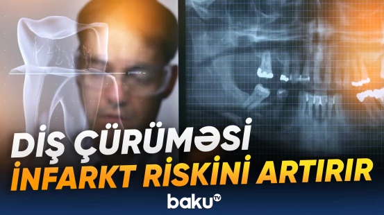 Mütəxəssislər çürük dişlərin yaratdığı ciddi təhlükə barədə xəbərdarlıq etdi
