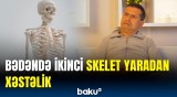 Daş adam xəstəliyi nədir? | Əgər bu əlamətlər varsa...