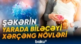 Şəkərin yarada biləcəyi xərçəng növləri