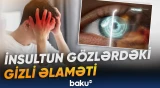 Göz müayinəsi insult riskinin erkən aşkarlanmasına imkan yarada bilər